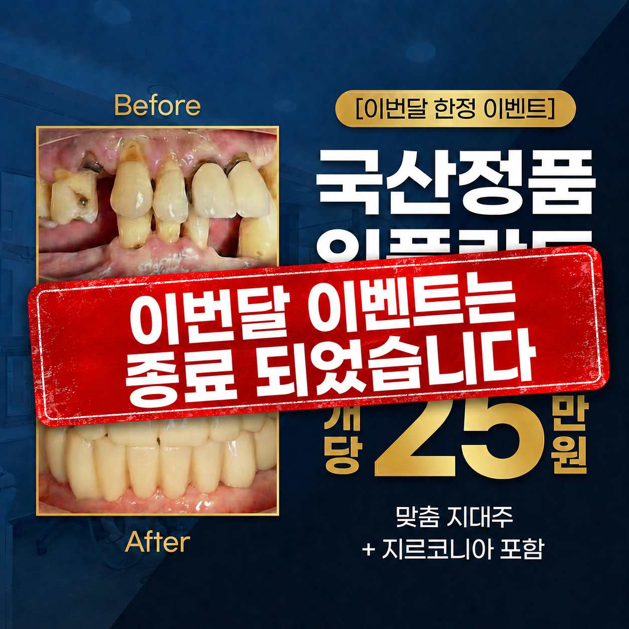 시흥 임플란트 국산정품 25만원 상담 안내